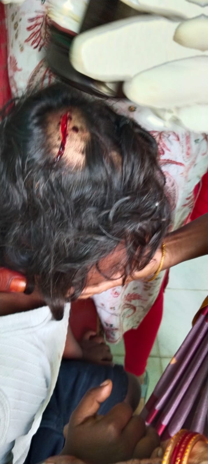 అయిజలో ఐదేళ్ల బాలికపై కోతుల దాడి.. తీవ్ర గాయాలు